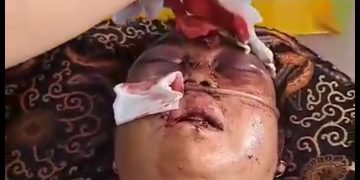 Betaherti, Korban Perampokan Sadis di Kota Solok Dirujuk ke M. Djamil Padang